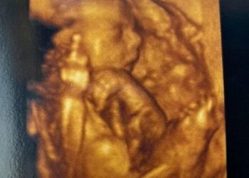 Bebê se despede de 2020 mostrando dedo do meio em ultrassom 