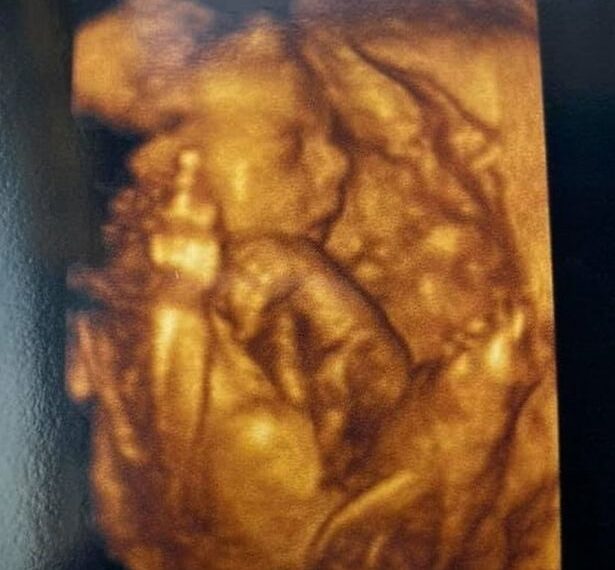 Bebê se despede de 2020 mostrando dedo do meio em ultrassom 