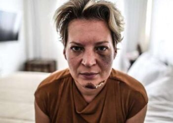 Polícia Civil do DF descarta agressão e diz que Joice sofreu queda em casa